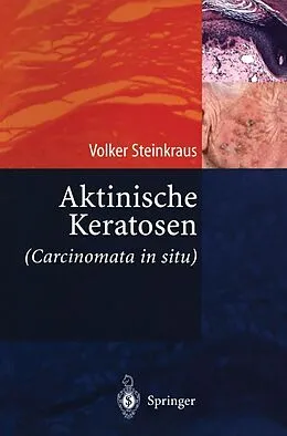 E-Book (pdf) Aktinische Keratosen (Carcinomata in situ) von Volker Steinkraus