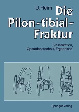 E-Book (pdf) Die Pilon-tibial-Fraktur von Urs Heim
