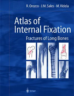 E-Book (pdf) Atlas of Internal Fixation von R. Orozco, J. M. Sales, M. Videla