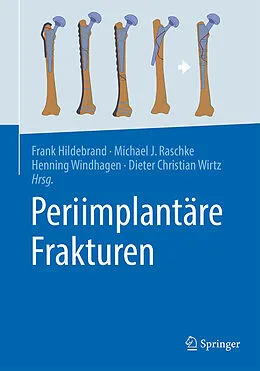 E-Book (pdf) Periimplantäre Frakturen von 
