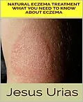 E-Book (epub) Natural Eczema Treatment von Jesus Urias