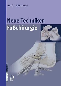 E-Book (pdf) Neue Techniken Fusschirurgie von Hajo Thermann
