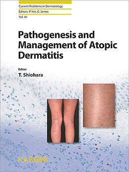 E-Book (pdf) Pathogenesis and Management of Atopic Dermatitis von 