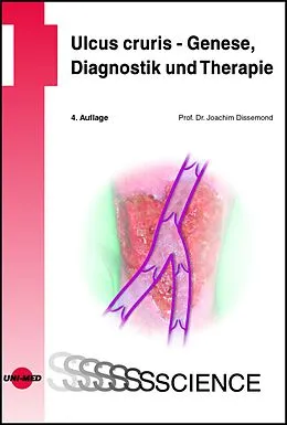 E-Book (pdf) Ulcus cruris - Genese, Diagnostik und Therapie von Joachim Dissemond