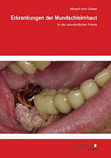 E-Book (pdf) Erkrankungen der Mundschleimhaut von Margrit-Ann Geibel