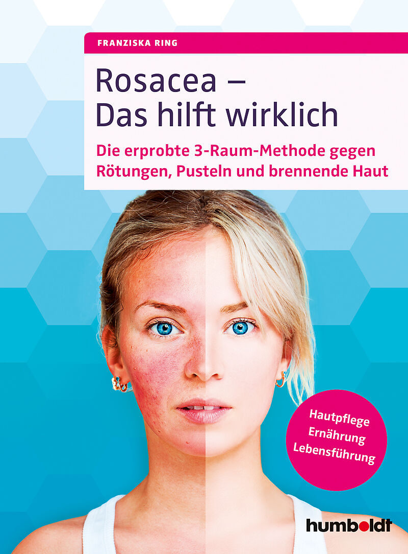 Rosacea  Das hilft wirklich