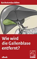 E-Book (epub) Wie wird die Gallenblase entfernt? von Bartholomäus Böhm