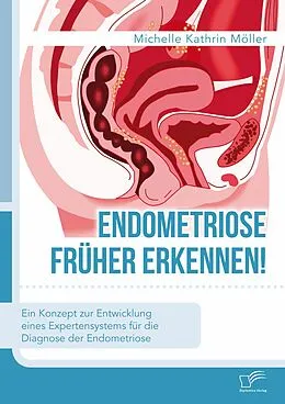 E-Book (pdf) Endometriose früher erkennen! Ein Konzept zur Entwicklung eines Expertensystems für die Diagnose der Endometriose von Michelle Kathrin Möller