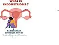 E-Book (epub) What Is Endometriosis (Endo)? & 14 Signs That You Might Have It von D. Christina